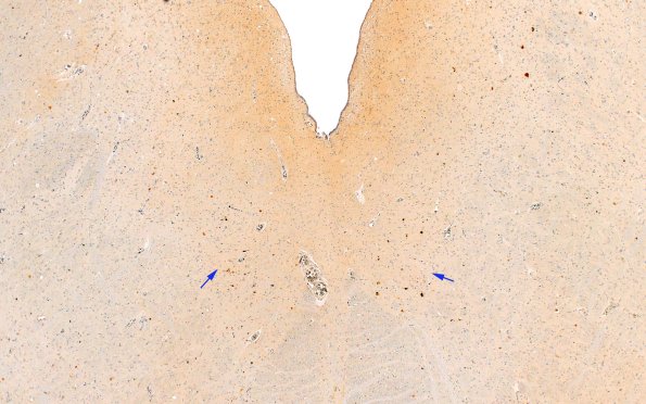 18D1 ALS (Case 18) N8 TDP43 2X copy