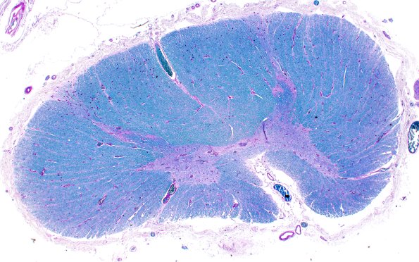 19D (Case 19) 2X LFB-PAS