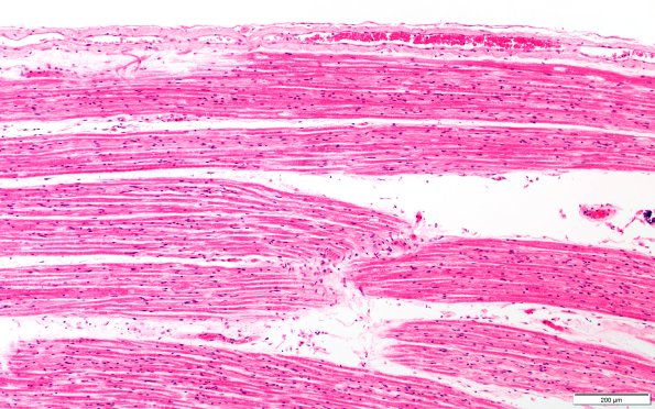 1B5 ALS (Case 1) Dorsal root 10X 1