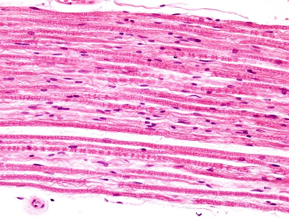 1B6 ALS (Case 1) Dorsal root 40X 1