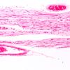 1B7 ALS (Case 1) Ventral root 10X 1A