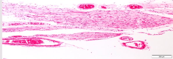 1B7 ALS (Case 1) Ventral root 10X 1A