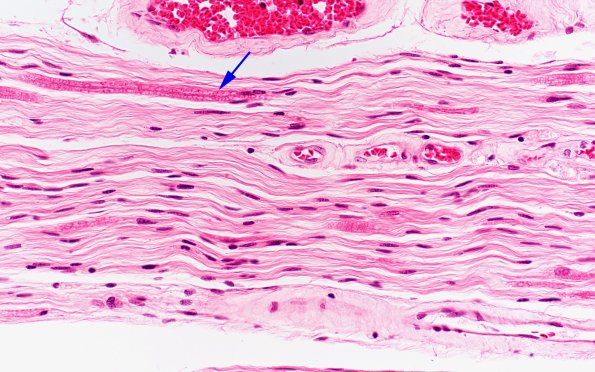 1B8 ALS (Case 1) Ventral root 40X 2 copy