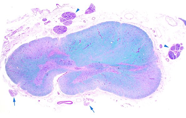 1C2 ALS (Case 1) N12 LFB-PAS 2X 1 copy.jpg