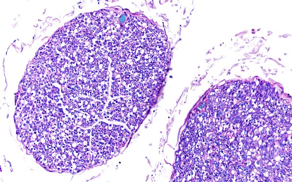 1C3 ALS (Case 1) N12 LFB-PAS DR 20X 1