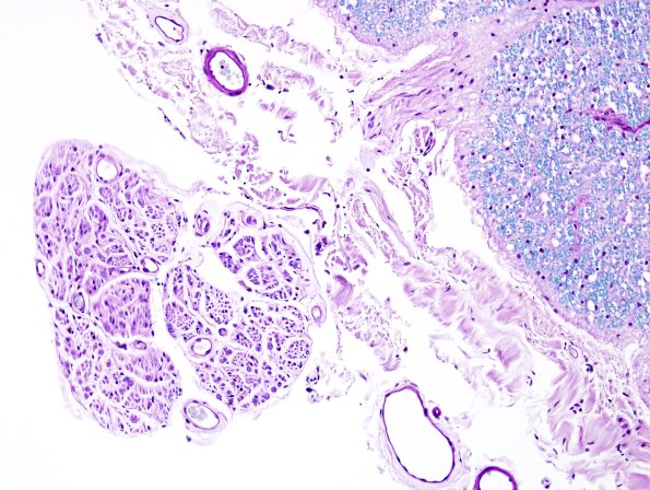 1C4 ALS (Case 1) N12 LFB-PAS VR 20X 1
