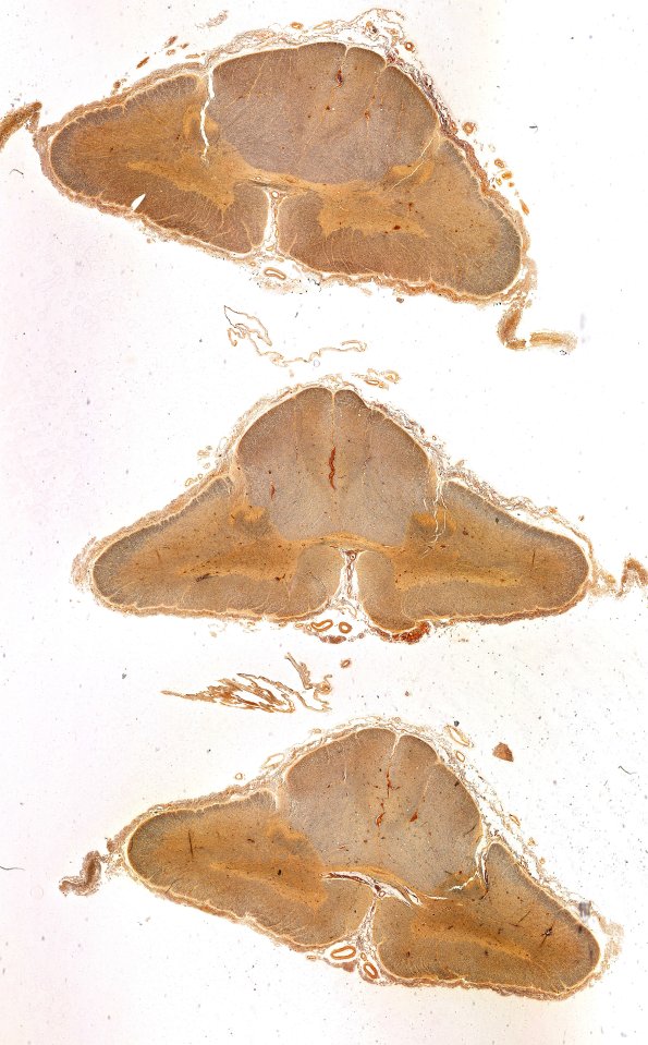 1D1 ALS (Case 1) N10 Biels WM 2