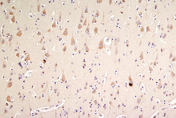 1E1 ALS (Case 1) N18-19 Precentral gyrus TDP43 6