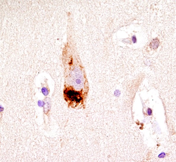 1E2 ALS (Case 1) N18-19 Precentral gyrus TDP43 3