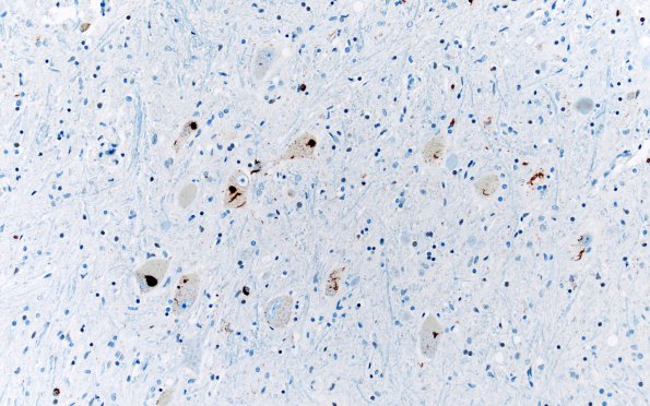 20C2 ALS (Case 20) N12 TDP43 20X 3