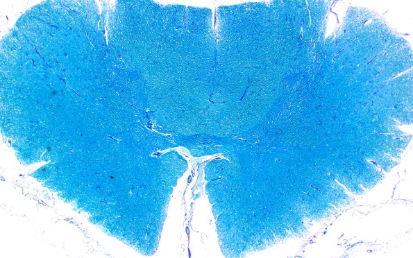 21C2 ALS (Case 21) LFB-PAS 2X 1