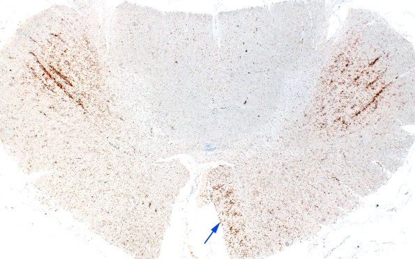 21C4A ALS (Case 21) CD68 2X 1 copy