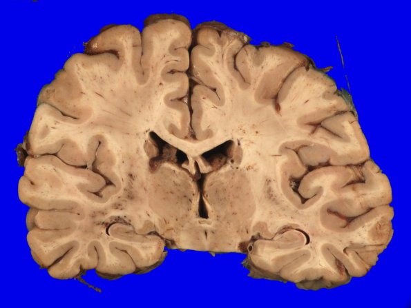 2A2 ALS (Case 2) 1 (Precentral gyrus level)