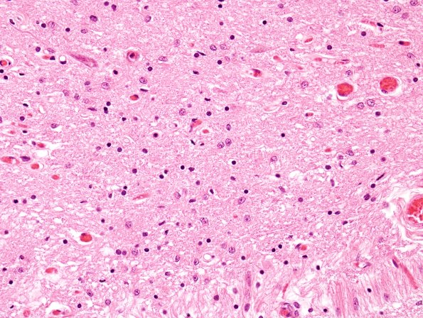 2B2 ALS (Case 2) N10 H&E 1