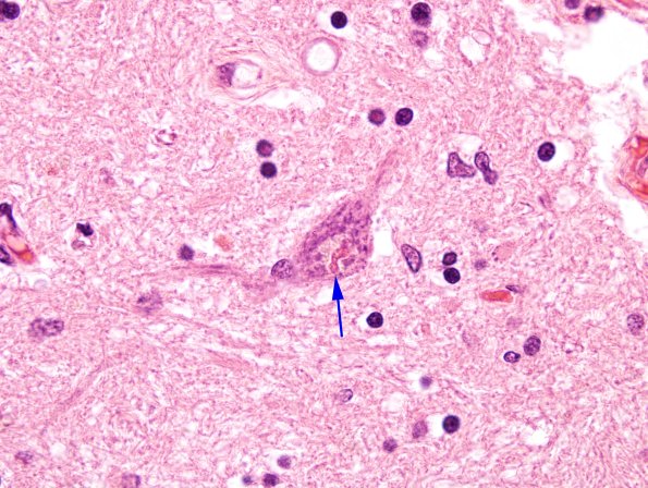 2B5 ALS (Case 2) N13 H&E 6 copy