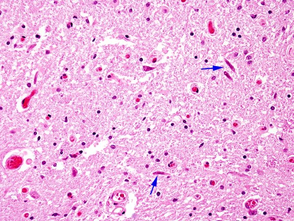 2B7 ALS (Case 2) Spinal cord H&E 3 copy