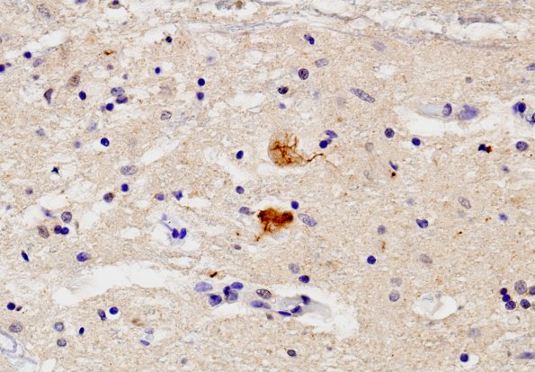 2C1 ALS (Case 2) Spinal cord TDP 5