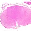 2D1 ALS (Case 2) N11 Thoracic H&E.jpg