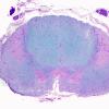 2E1 ALS (Case 2) N11 Thoracic LFB-PAS 2XA.jpg