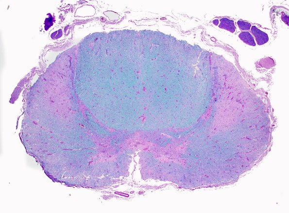 2E1 ALS (Case 2) N11 Thoracic LFB-PAS 2XA.jpg