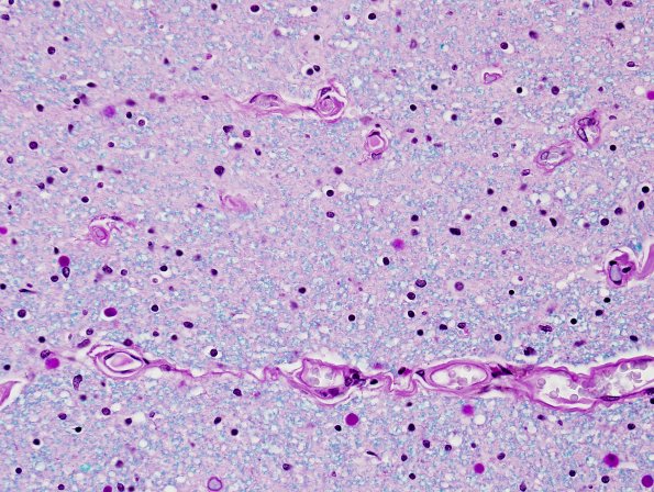 2E3 ALS (Case 2) N10 Cx LFB-PAS Corticospinal 40X