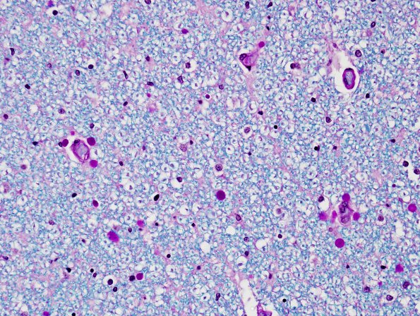 2E4 ALS (Case 2) N10 Cx LFB-PAS Dorsal Column 40X