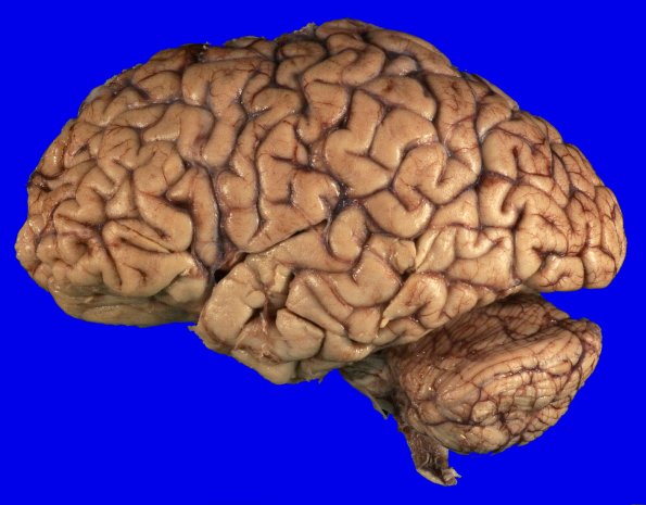 3A ALS, pre atrophy (Case 3) Gross _3