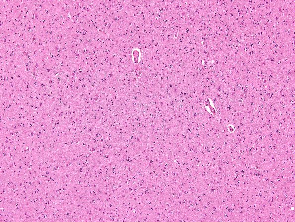 3B2 ALS, precentral gyrus atrophy (Case 3) N15 precentral H&E 2.jpg