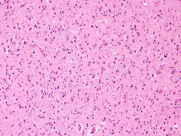 3B3 ALS, precentral gyrus atrophy (Case 3) N15 precentral H&E 1.jpg