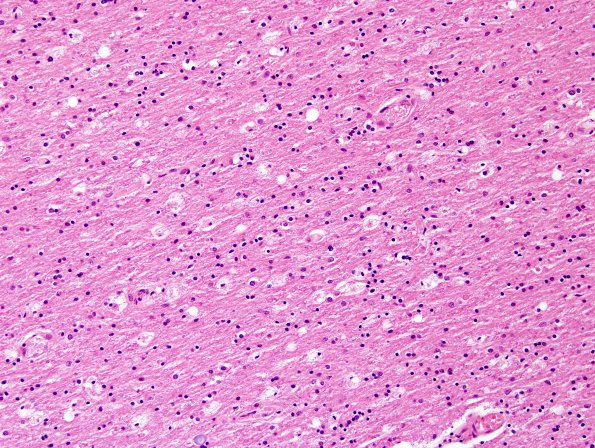 3B4 ALS, precentral gyrus atrophy (Case 3) N14 precentral H&E 2.jpg