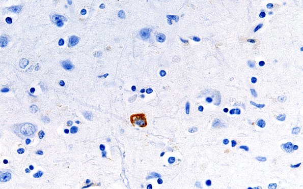 3B5 ALS, precentral gyrus atrophy (Case 3) N15 precentral TDP43 60X