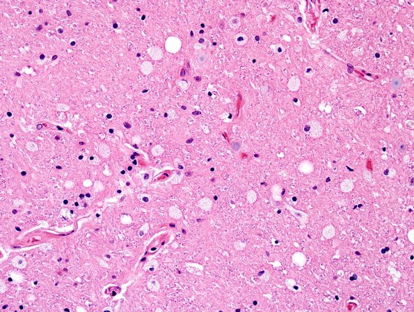 3D ALS (Case 3) N10 Lat CS tract 1.jpg