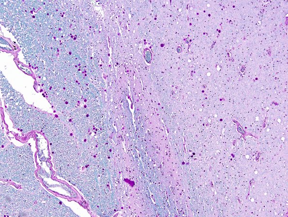 3E2 ALS, precentral gyrus atrophy (Case 3) N10 LFB-PAS 10X.jpg