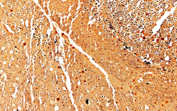 3F3 ALS (Case 3) N11 Thoracic Biels 20X