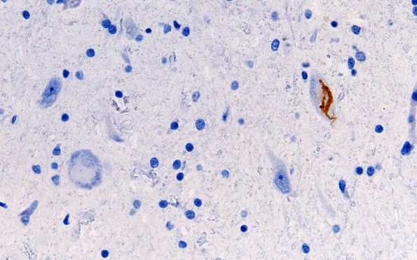 3G1 ALS (Case 3) N8 XII nucTDP43 60X 2