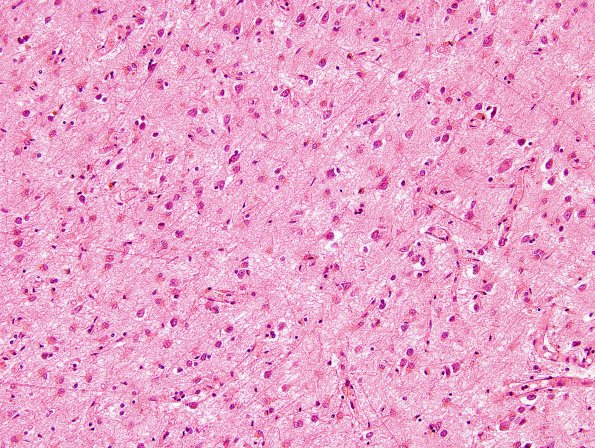 4B3 ALS (Case 4) precentral gyral atrophy H&E 2