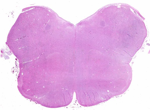 4D1 ALS (Case 4) precentral gyral atrophy Medulla H&E whole mount