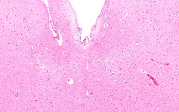 4D2 ALS (Case 4) Medulla Hypoglossal Nuc H&E 4X