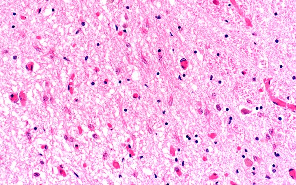 4D3 ALS (Case 4) Medulla Hypoglossal Nuc H&E 40X