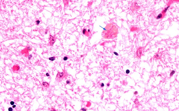 4D4 ALS (Case 4) Medulla Hypoglossal Nuc H&E 100X copy