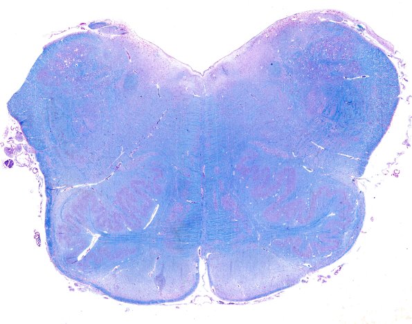 4D5 ALS (Case 4) Medulla LFB-PAS whole mount