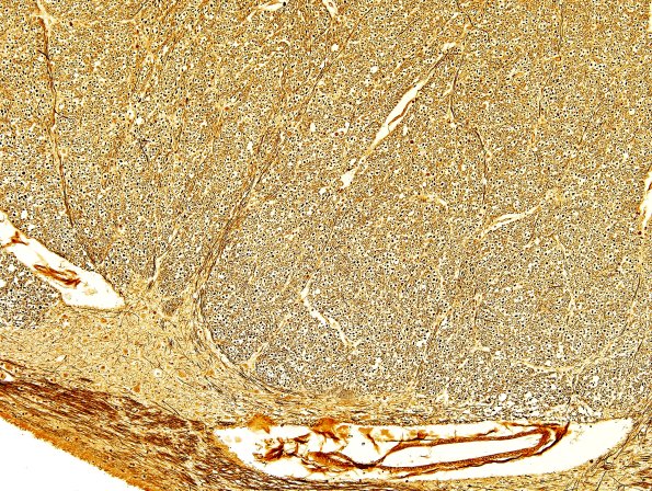 4D6 ALS (Case 4) Medulla Biels 10X Pyramid (Control A30970) 1