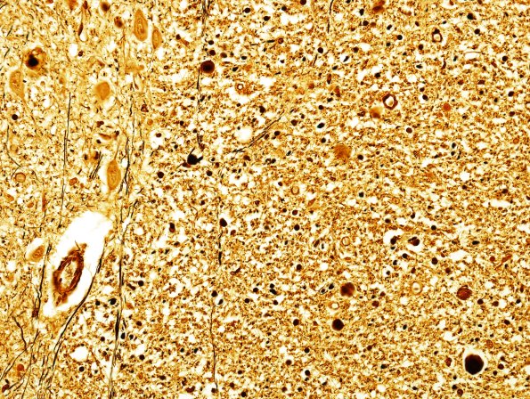 4D9 ALS (Case 4) Medulla Biels 40X Pyramid 1