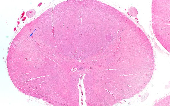 4E1 ALS (Case 4) H&E 2X copy