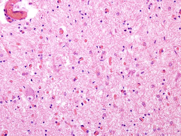 4E2 ALS (Case 4) Spinal Cord H&E 1 astrocytosis