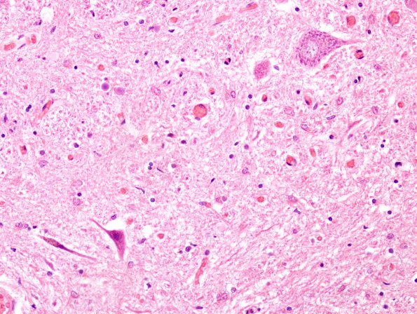 4E3 ALS (Case 4) Spinal Cord H&E 1 atrophic neurons 2