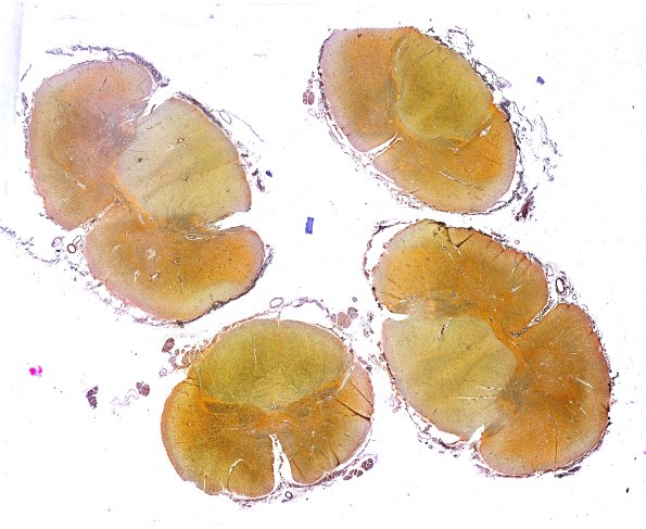 4G1 ALS (Case 4) Spinal Cord Biels WM