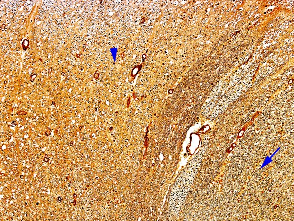 4G3 ALS (Case 4) Thoracic Cord Biels 10X Lat CS-Dorsal Column tracts 1 copy