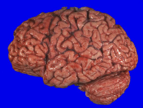 5A1 FTLD-ALS (Case 5) Gross _3