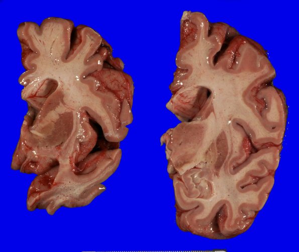 5A2 FTLD-ALS (Case 5) Gross _8